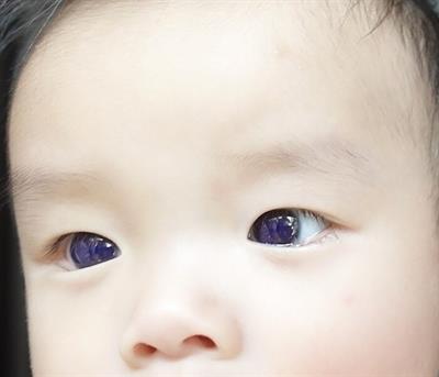 Case report: Favipiravir-induced bluish corneal discoloration in infant with COVID-19